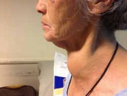 Phòng bệnh tuyến giáp, hãy kiểm tra i-ốt theo cách này ngay