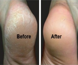 Mẹo chữa chai chân cực đơn giản cho đôi chân luôn mịn màng