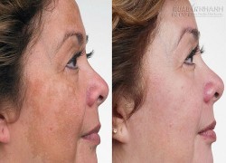 Biến làn da nám, đồi mồi thành trắng mịn trong 15 phút