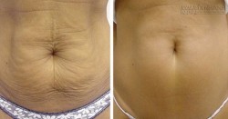 Kéo căng vùng da bị chảy xệ một cách tự nhiên