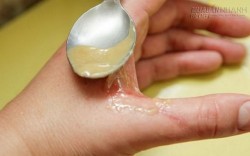 Mẹo trị bỏng bằng những nguyên liệu đơn giản ngay tại nhà