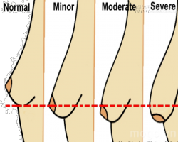 3 công thức giúp nâng cấp bộ ngực chảy xệ trên cả tuyệt vời