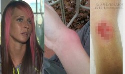 Bị nhiễm trùng khi đeo dây buộc tóc lên cổ tay