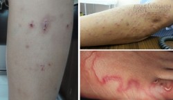 Triệu chứng nhiễm giun sán ít ngờ nhất