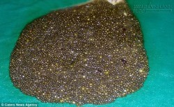 Người phụ nữ có 11950 viên sỏi mật trong người