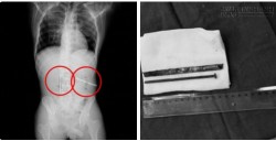 Liều lĩnh nuốt chửng đinh và dao răng cưa