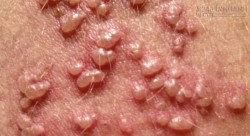 Bệnh nguy hiểm dễ lây khi quan hệ cần phòng trước khi quá muộn