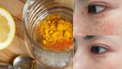 Hô biến vết sạm, nám, tàn nhang chỉ mất 15 phút để thực hiện