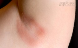 Trị nấm ngứa da, hãy sử dụng 2 nguyên liệu trong nhà bếp này