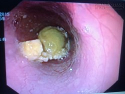 Nuốt mật heo sống, sản phụ suýt tử vong