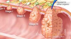 Ung thư đại trực tràng: Ai không may mắc thì đừng tuyệt vọng!