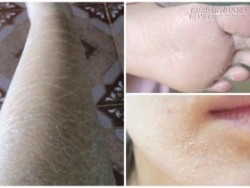 2 cách cực đơn giản để tạm biệt tình trạng da rắn xấu xí mùa hanh khô