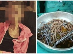 Cô gái trẻ rước họa vào thân vì giảm cân bằng cách uống viên nang chứa trứng giun đũa