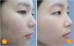 Làn da bóng dầu, nhiều mụn trở nên trắng mịn chỉ sau 10 ngày với hỗn hợp siêu rẻ