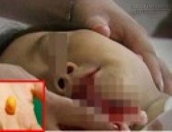 Người phụ nữ gẫy nguyên hàm răng vì đang ăn cơm nhai trúng vật báu