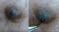 Điều gì xảy ra khi nhổ lông trên nốt ruồi?