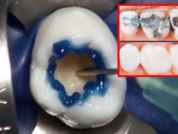 Tận mắt chứng kiến quá trình trám răng nha khoa khiến ai cũng thấy ê buốt không tưởng