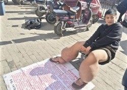 Xót xa thanh niên 23 tuổi mắc bệnh chân voi atrời lạnh nhưng không thể mặc quần
