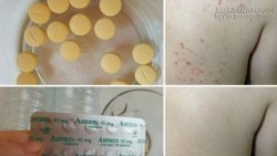 Mẹo trị viêm lỗ chân lông thần thánh chỉ bằng Aspirin!