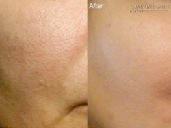 Nhật ký thu nhỏ lỗ chân lông trong vòng 17 ngày