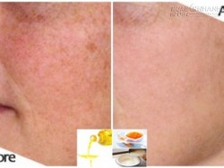 Bất ngờ với cách trị nám vĩnh viễn từ dầu ăn