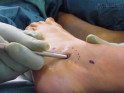 Rợn tóc gáy khi lấy thứ này ra khỏi bàn chân