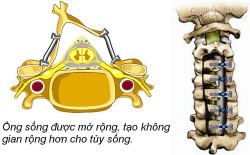 Tê mỏi tay lâu ngày coi chừng bị hẹp ống sống cổ do thoái hóa