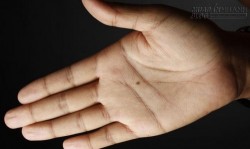 Ai có nốt ruồi kiểu này thì nên đọc ngay bài viết này