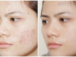 Tạm biệt vết thâm xấu xí trong nháy mắt với hỗn hợp cực rẻ từ thiên nhiên