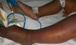 Đắp lá lên vết rắn cắn, cháu bé rối loạn đông máu nặng