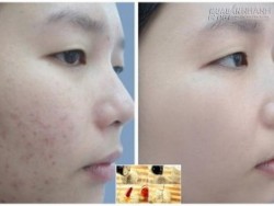 Da sần sùi, thâm nám đến đâu, cứ áp dụng hỗn hợp sau là trở nên trắng mịn