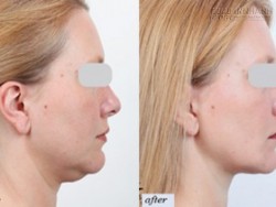 Loại bỏ cằm 2 ngấn chưa bao giờ dễ dàng đến thế