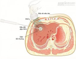 Ung thư gan: Cách phát hiện và phòng bệnh