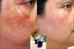 Bất ngờ với nước bí đao thổi sạch chân nám vĩnh viễn dễ như trở bàn tay