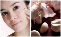 Tự tẩy nốt ruồi tại nhà để đón năm mới