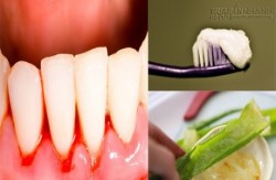 Tự chữa chảy máu chân răng ngay tại nhà với nguyên liệu đơn giản