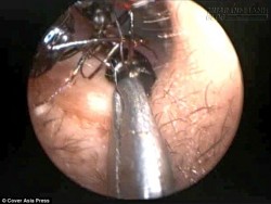 Đi tìm nguyên nhân khiến hơn 1 nghìn con kiến bò ra từ lỗ tai bé gái 12 tuổi