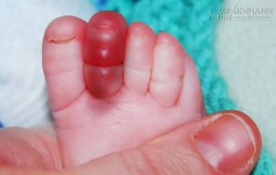 Trẻ hoàn toàn có nguy cơ mất ngón chân chỉ bằng… một sợi tóc