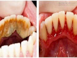 Cách lấy cao răng tại nhà hiệu quả và an toàn nhất