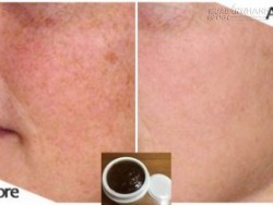 Nám da nặng và lâu đến đâu, cứ áp dụng hỗn hợp này chắc chắn khỏi