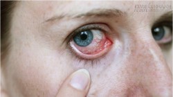 Mẹo chữa trị đau mắt đỏ tự nhiên