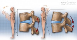 Các bài tập cho thoát vị đĩa đệm cột sống thắt lưng