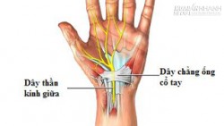 Hội chứng ống cổ tay và cách điều trị