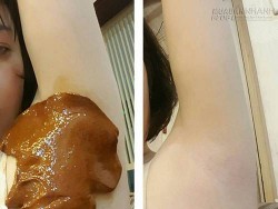 Hỗn hợp thần thánh giúp nách không bao giờ thâm mà còn sạch bong từng cọng lông