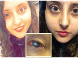 Cô gái 18 tuổi suýt mất cả đôi mắt vì rửa kính áp tròng bằng thứ nước này