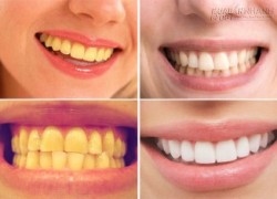 Răng trắng sáng, hết mảng bám sau 1 tuần nhờ hỗn hợp rẻ như cho