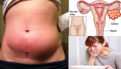 10 triệu chứng của kẻ giết người thầm lặng, có khi chị em bị rồi mà không biết!