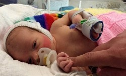 Sức sống mãnh liệt của em bé sinh ra với ruột nằm ngoài ổ bụng