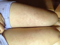 Trị dứt điểm viêm lỗ chân lông bằng cách đơn giản