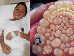 Sốc: Bé trai 9 tuổi mọc gần 300 chiếc răng trong miệng